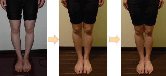 奈良・生駒のまるふく総合整体院のO脚矯正　変化例1