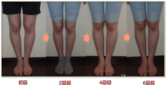 奈良・生駒のまるふく総合整体院のO脚改善例　奈良県生駒市在住の方