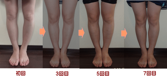 O脚矯正変化例2 奈良・生駒のまるふく総合整体院のO脚矯正変化例 奈良市在住の方