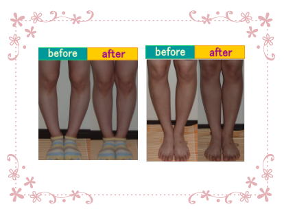 O脚改善 before after ② 奈良・生駒のまるふく総合整体院
