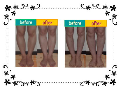 O脚改善 before after ③ 奈良・生駒のまるふく総合整体院