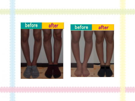 O脚改善 before after ⑥ 奈良・生駒のまるふく総合整体院
